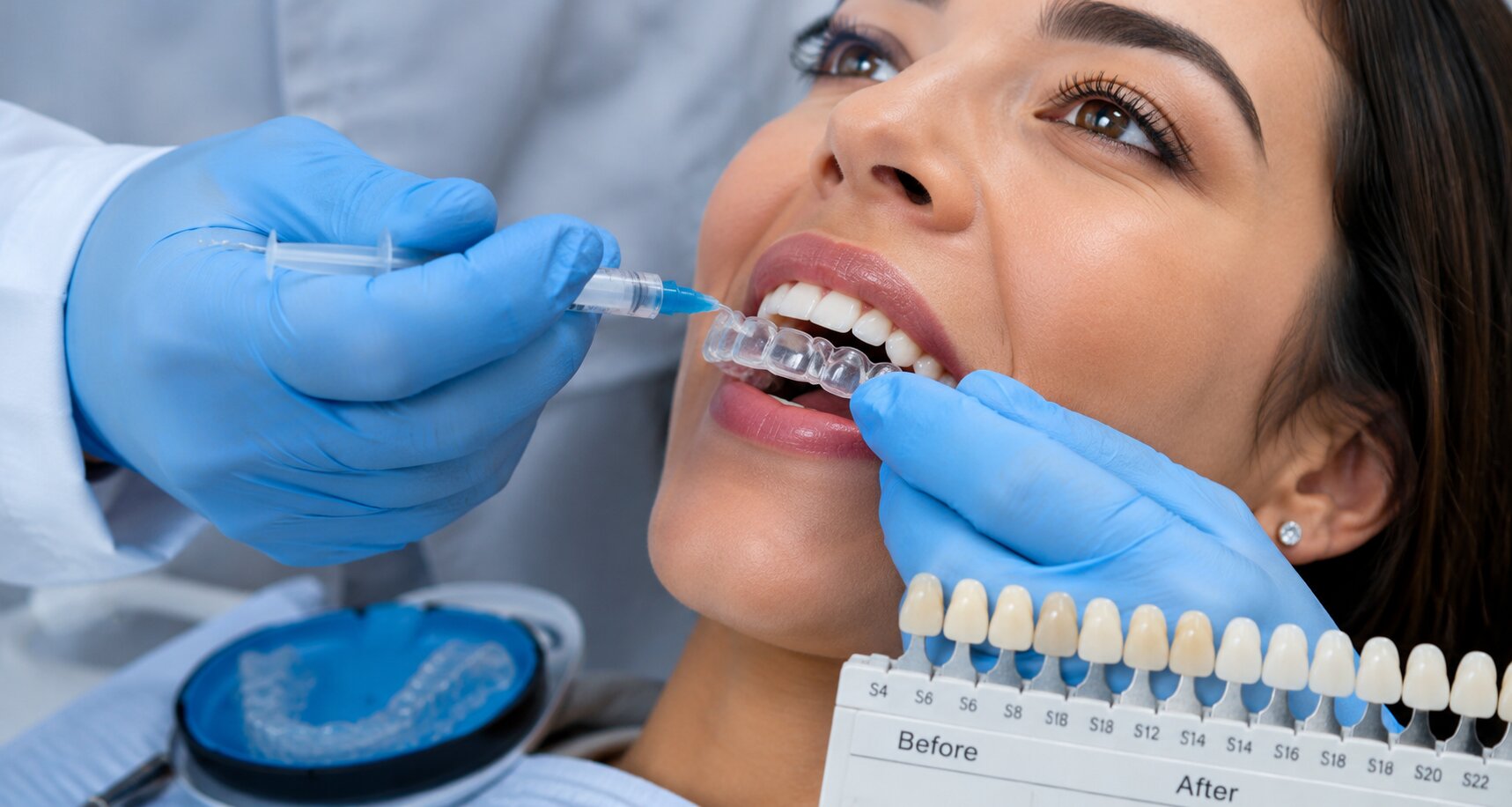 Dentist applying take-home whitening gel with a shade guide showing before and after tooth color